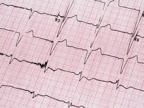 jak odczytywać ekg