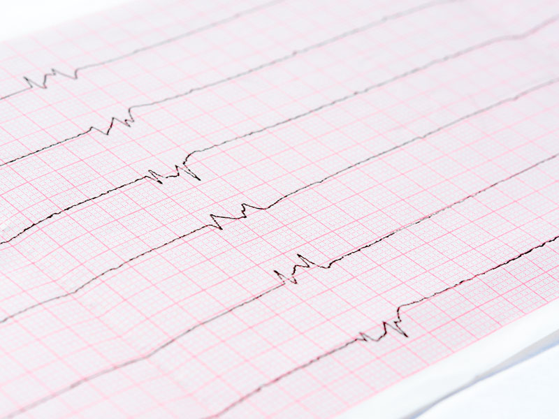 ekg asystolia