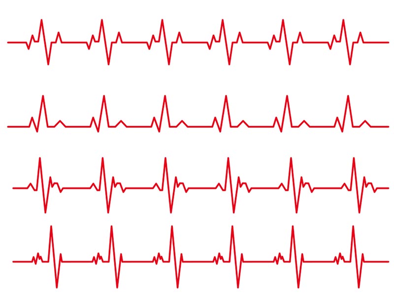 rozne typy wykresow ekg