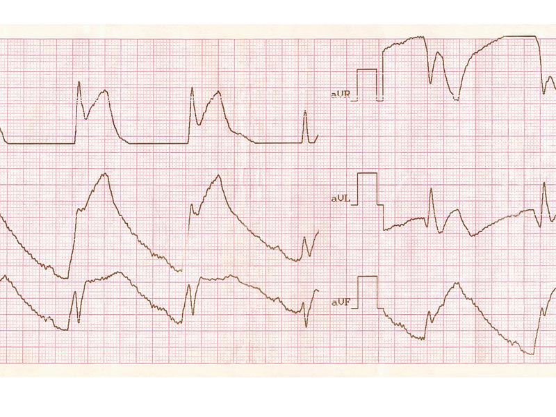 zapalenie osierdzia na ekg