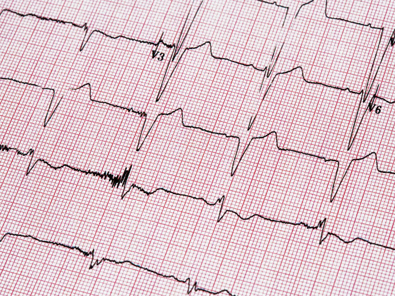 rozowy wykres ekg